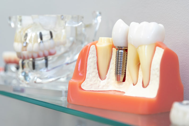 dental implant model