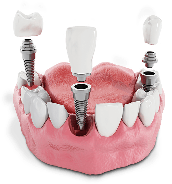dental implant procedure Overland Park, KS
