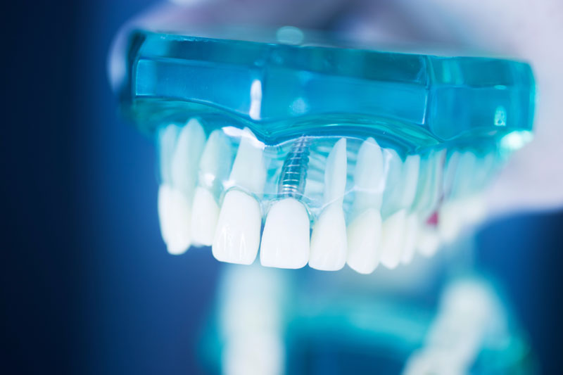 Discover the Promising World of Teeth Implants in Lee’s Summit, MO