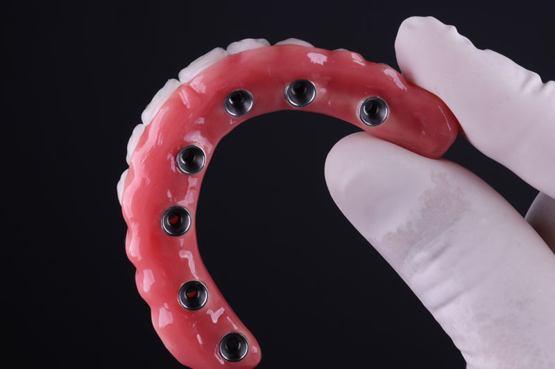 Dental Implants Prosthetic Porcelain Rehabilitation, dentist is holding the model in a dark room with white gloves