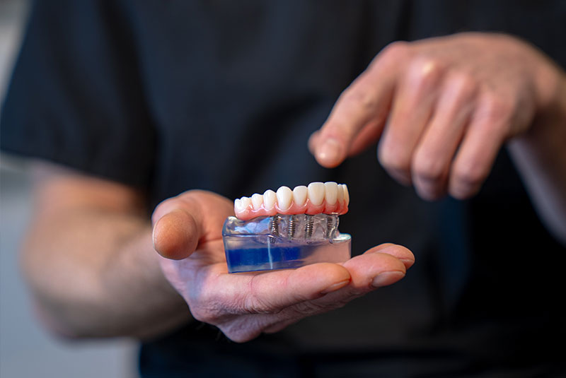 dental implant full arch