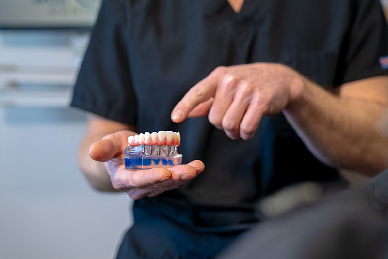 full mouth implant model